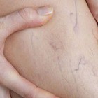 Rozšírené cievky – vopred prehratý boj?